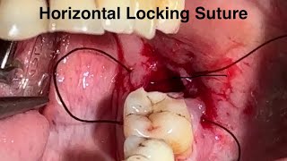 Horizontal locking suture post extraction l 7044611705 l DrArindam Mandaloralsurgery [upl. by Naujed]