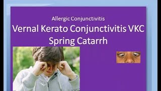 Ophthalmology 088 a Vernal KeratoConjunctivitis VKC Spring Catarrh Allergic Horner Tranta Eye [upl. by Hartman]