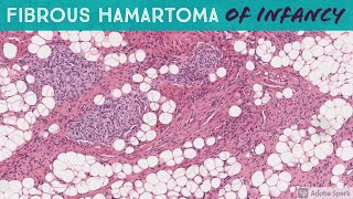 Fibrous Hamartoma of Infancy [upl. by Kcirej917]