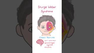 Sturge Weber Syndrome [upl. by Tova]