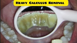 Teeth Cleaning Procedure  Plaque Removal  Tartar Removal  How a Dentist do Scaling of Teeth [upl. by Ruttger]