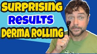 How To Get AMAZING Results With DERMA ROLLER  Chris Gibson [upl. by Atnuhs]