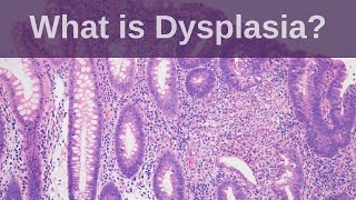 What is Dysplasia  Pathology mini tutorial [upl. by Diver]