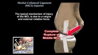 Medial Collateral Ligament Injuries  Everything You Need To Know  Dr Nabil Ebraheim [upl. by Atika]