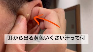 耳瘻孔を絞ってみた Squeezing my preauricular sinus [upl. by Assiroc]