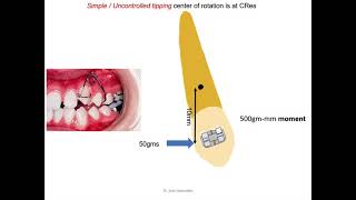 Basics of Biomechanics 2 types of tooth movement and couple [upl. by Orsa]