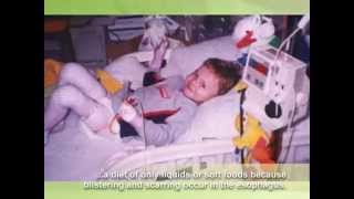 Epidermolysis Bullosa EB Awareness video extended [upl. by Ynaffets]