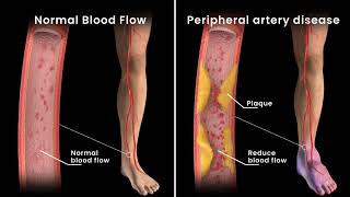 Peripheral Artery Disease Angioplasty [upl. by Eiffub418]