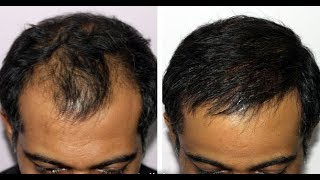 Hair growth with evion and zincovit 100 works Drsiddh zincovit evion [upl. by Esidnak579]