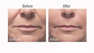 Botox vs Dermal Fillers [upl. by Merritt]