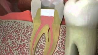 Dentist  Root Canal Retreatment [upl. by Artied]