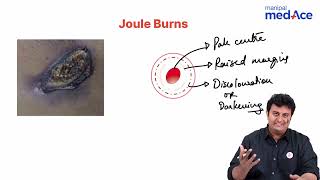 Forensic Medicine amp Toxicology  Joule burns [upl. by Gui566]