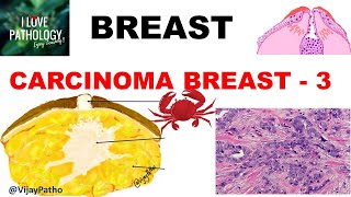 Diseases of Breast Part 6 Breast carcinoma InvasiveTypes MorphologyPrognosis amp treatment [upl. by Atikal]