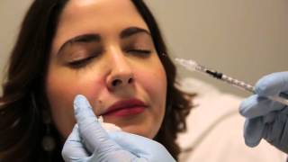 Botulinum Toxin Injection for Gummy Smile [upl. by Dione]