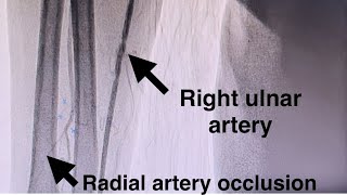 How To Puncture The Ulnar Artery in Ipsilateral Radial Artery Occlusion Anterior Puncture Technique [upl. by Ettennad]