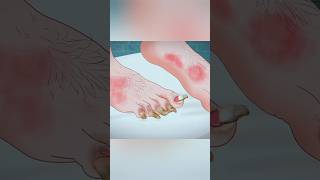 ASMR Toe Treatment  2D Animation Surgery 2danimation treatment surgery asmr shorts viral [upl. by Ameer907]