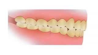 Common Dental Problems Plaque [upl. by Etrem]