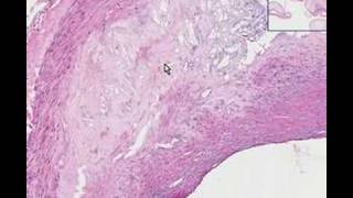 Histopathology Coronary arteriesAtherosclerosis [upl. by Edahs]