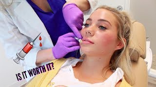 I GOT MY LIPS DONE IS IT WORTH IT VLOG [upl. by Boylston913]