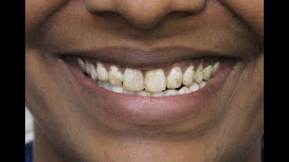 Do you hide your teeth due to Fluorosis Find out the best treatmentVideo by Dr Trivikram [upl. by Nettirb]