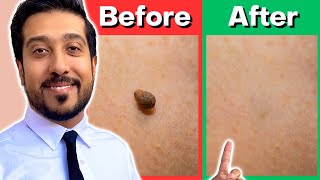 How to Remove Skin Tags Yourself AT HOME  Get Rid of Skin Tags NOW [upl. by Alyek]