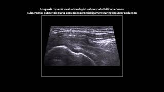 Subacromial impingement on dynamic realtime shoulder ultrasound case 6 [upl. by Ambrogio282]