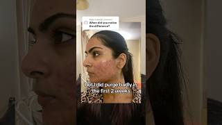 When did I start seeing accutane results acne accutane skincare [upl. by Sinnaiy]