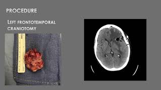 AANS Coding Shorts Craniotomy for Resection of a Supratentorial Metastatic Brain Tumor [upl. by Sankaran]