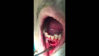 Dental Oral Surgery Apicoectomy Taibah University College of Dentistry [upl. by Nicolella]