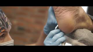 PODOPHARM® Treatment of cracked heels in a podiatry practice [upl. by Ddat]