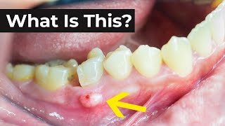 What is an Abscessed Tooth amp What To Do About It [upl. by Airenahs]