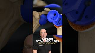 Shoulder Replacement Surgery What You NEED To Know [upl. by Nolava]