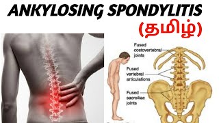 Ankylosing Spondilitis  Causes  Symptoms  Treatment  தமிழ் [upl. by Yrtua51]