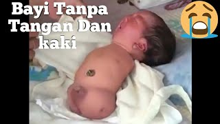 Kasian Anak iniDia lahir tanpa tangan Dan Kaki [upl. by Ivana]