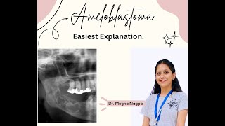 Ameloblastoma01  Easiest Explanation  Oral Pathology  BDS [upl. by Asilram]