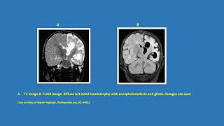 Neurology Quiz 80 Rasmussens encephalitis [upl. by Ruffo293]