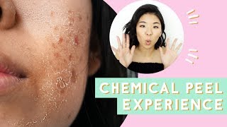 ✂ Chemical Peel for Acne amp Scars Before amp After [upl. by Rothwell265]