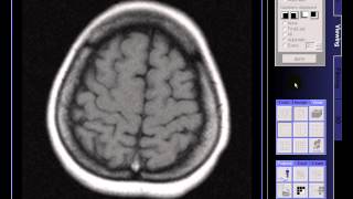 BRAIN MRI IN CASE EARLY ATROPHY [upl. by Giorgia]