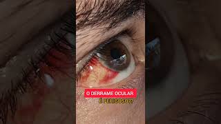 Derrame ocular é perigoso [upl. by Absalom]