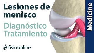 😩😩ROTURA DE MENISCO ► Diagnóstico y tratamiento de fisioterapia médico y quirúrgico [upl. by Rogovy]