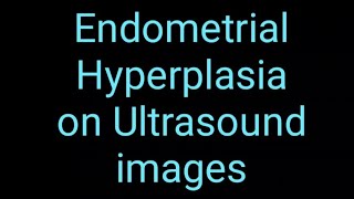 Endometrial Hyperplasia on Ultrasound Imaging [upl. by Anaahs]