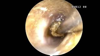 Endoscopic ear cleaning [upl. by Bernetta]