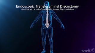 Endoscopic Transforaminal Approach for a Herniated Disc [upl. by Gratiana]