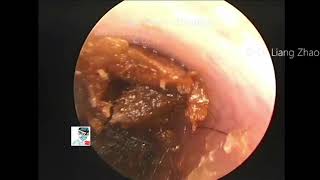 Enucleation embolization and external auditory canal cholesteatoma 12 minutes [upl. by Waddle817]