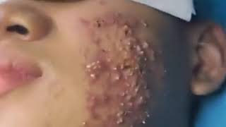 His Face Acne  Blackhead  Blackhead Removal on forehead  Remove Blackhead [upl. by Corwun]