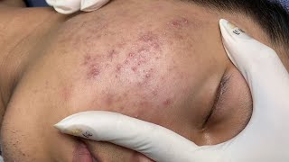 ACNE TREATMENT VU QUYNH MI Acne On Boys Chin 2024 [upl. by Anegroeg]