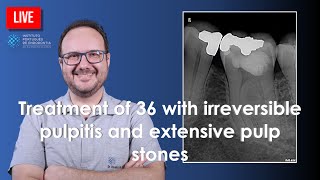 🔴 Treatment of 36 with irreversible pulpitis and extensive pulp stones [upl. by Eelreveb570]