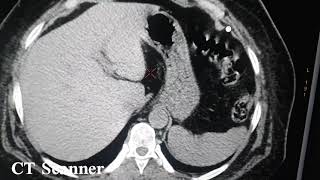 lithiase rénal TDM Abdominale sans injection [upl. by Aurie]