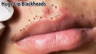 Removes a lot of blackheads on upper and lower lips  Satisfaction and Relaxation Videos 2024  Tips [upl. by Ekez]