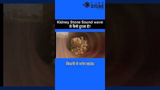 ESWL  Lithotripsy  Kidney Stone Treatment  Retrograde Intrarenal Surgery  shorts [upl. by Neeoma]